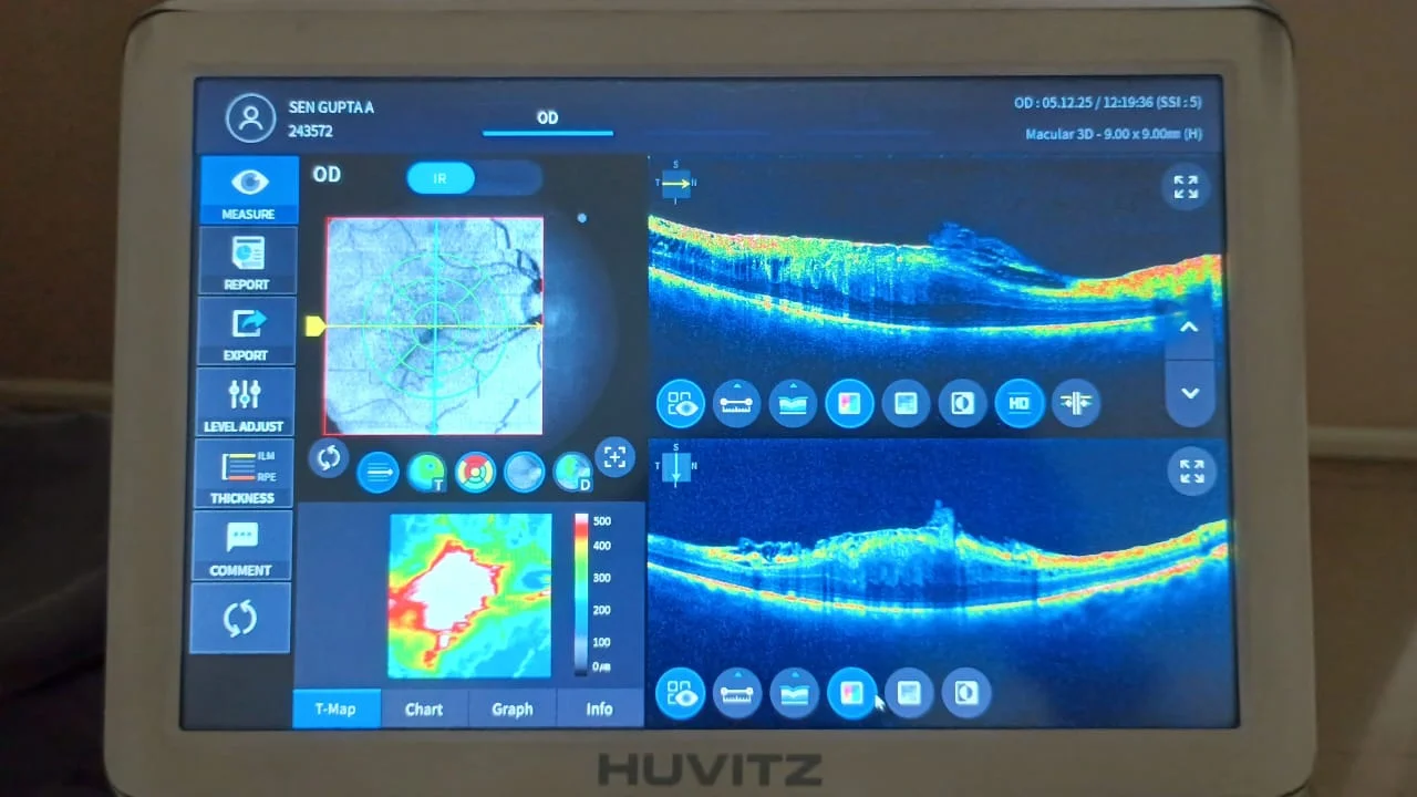OCT (Optical Coherence Tomography)